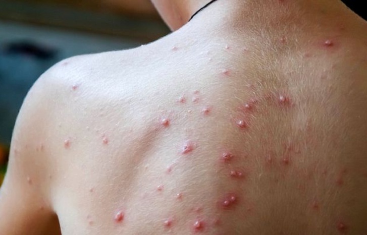 جدري القردة: ثلاث حالات يشتبه في إصابتها بالمغرب جدري القردة: ثلاث حالات يشتبه في إصابتها بالمغرب