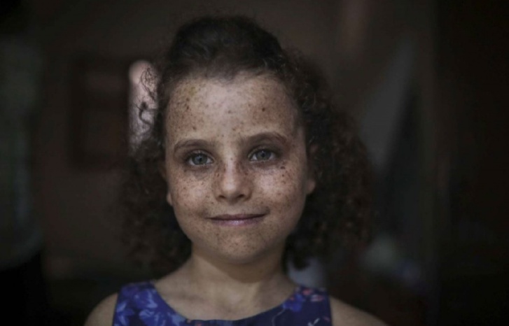 أطفال القمر.. المرض النادر أطفال القمر.. المرض النادر