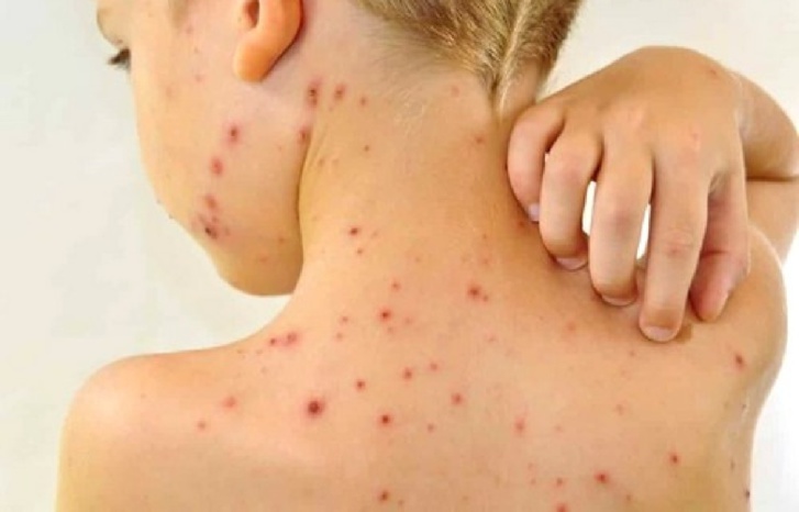 الأمراض الجلدية الناتجة عن الاصطياف، كيف يمكن تجنبها ؟ الأمراض الجلدية الناتجة عن الاصطياف، كيف يمكن تجنبها ؟