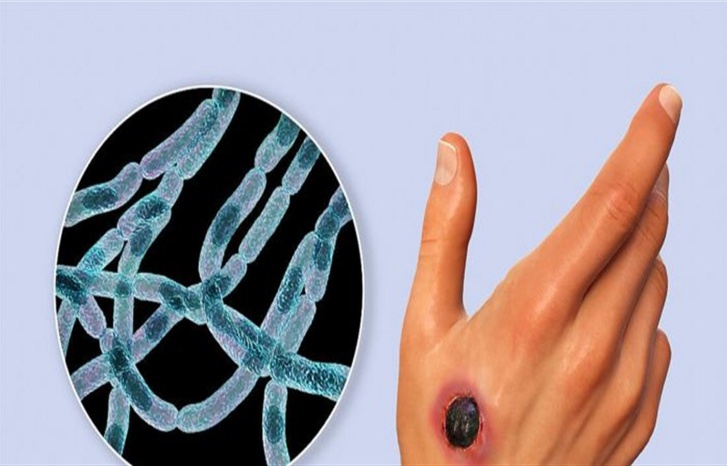 الجمرة الخبيثة تتفشى في إندونيسيا مع ارتفاع حصيلة الوفيات الجمرة الخبيثة تتفشى في إندونيسيا مع ارتفاع حصيلة الوفيات