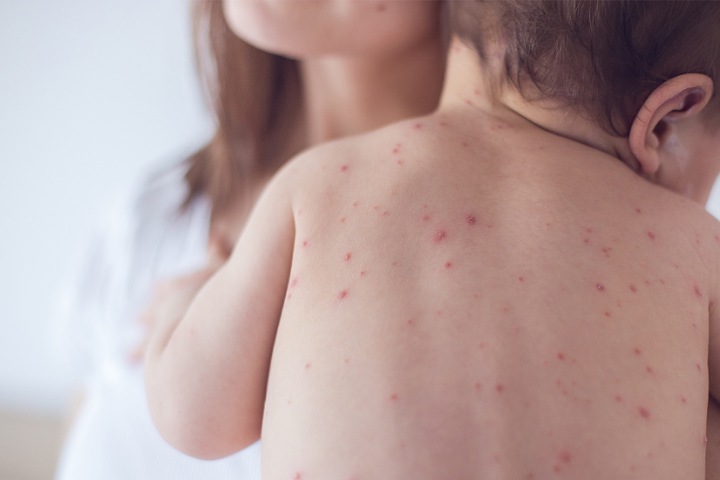 وزارة الصحة تحذر من ارتفاع حالات الإصابة بـ"بوحمرون" وزارة الصحة تحذر من ارتفاع حالات الإصابة بـ"بوحمرون"