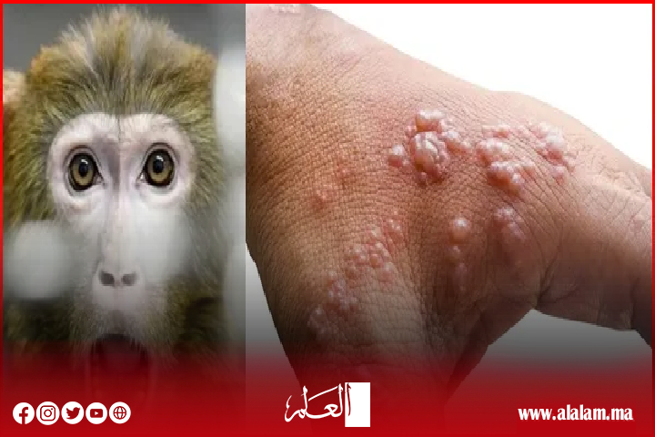 "جدري القردة": منظمة الصحة العالمية تفرض حالة طوارئ صحية عالمية "جدري القردة": منظمة الصحة العالمية تفرض حالة طوارئ صحية عالمية
