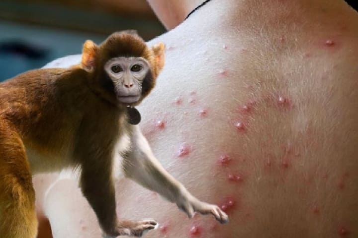 وزارة الصحة تتابع انتشار جدري القردة وتحين خطة الرصد والاستجابة وزارة الصحة تتابع انتشار جدري القردة وتحين خطة الرصد والاستجابة