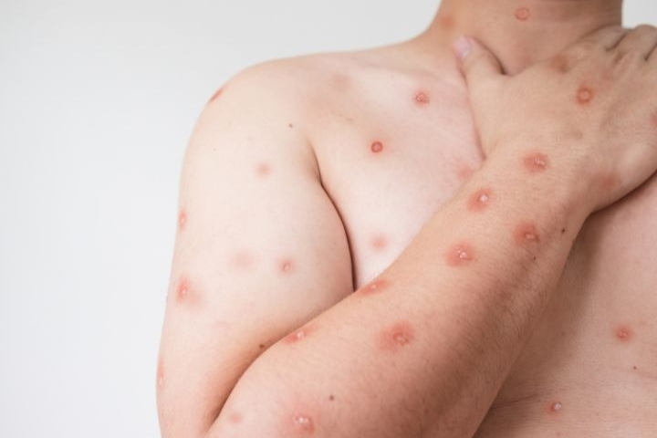 حمضي يكشف 10 اختلافات رئيسية بين جدري القرود والجديري المائي حمضي يكشف 10 اختلافات رئيسية بين جدري القرود والجديري المائي