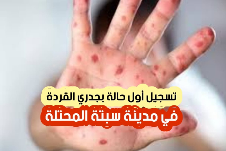 جدري القردة على أبواب المغرب جدري القردة على أبواب المغرب