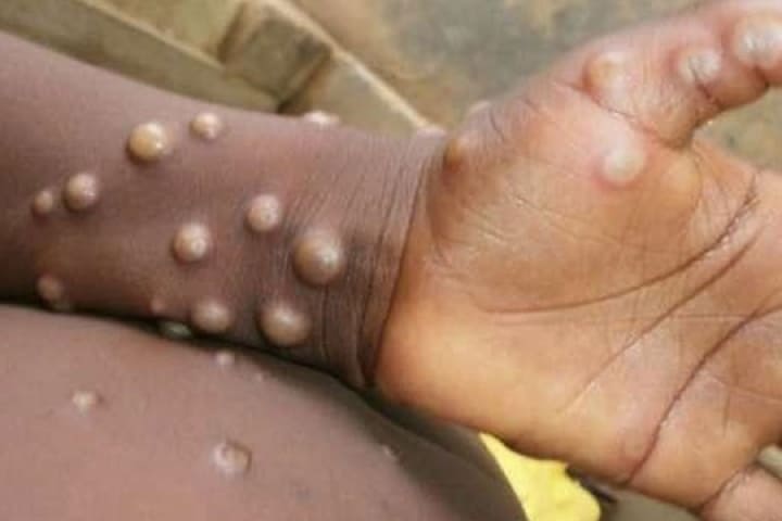 بسبب جدري القردة.. تأجيل تنظيم المؤتمر الدولي للصحة العامة بإفريقيا في المغرب بسبب جدري القردة.. تأجيل تنظيم المؤتمر الدولي للصحة العامة بإفريقيا في المغرب