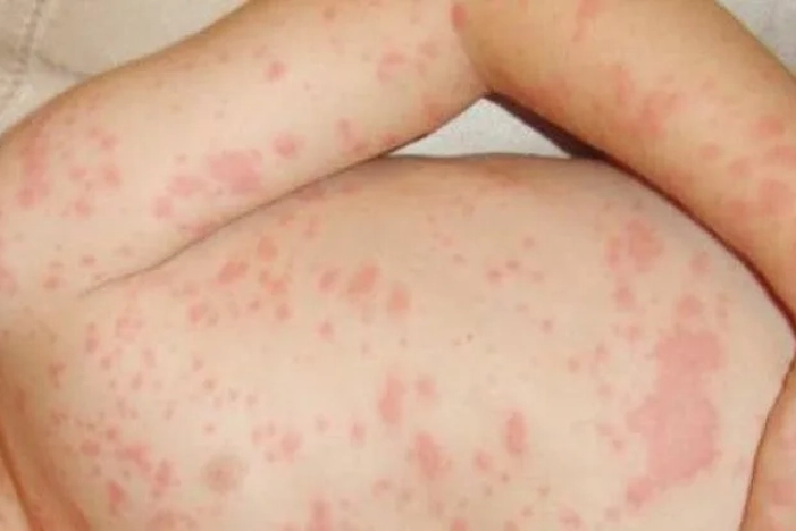 مندوبية الصحة تطلق حملة تلقيح ضد "بوحمرون" في العرائش مندوبية الصحة تطلق حملة تلقيح ضد "بوحمرون" في العرائش