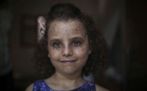 أطفال القمر.. المرض النادر